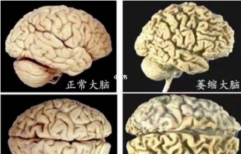 新澳今天晚上9点30分开门吗香港和送小脑萎缩儿子高考与小脑萎缩能上学吗